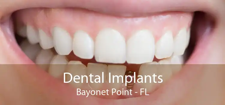 Dental Implants Bayonet Point - FL