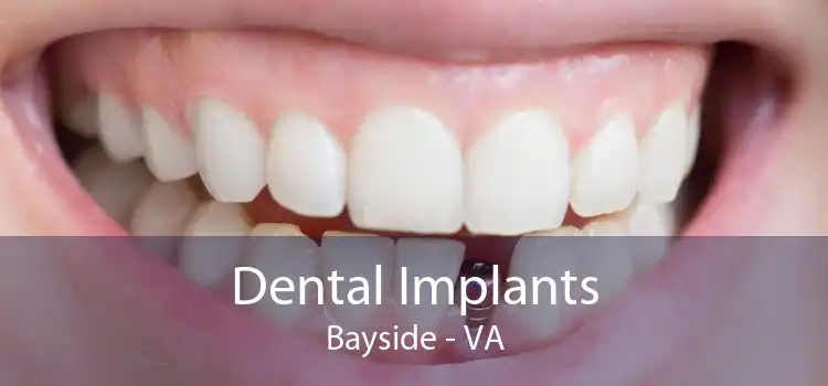 Dental Implants Bayside - VA
