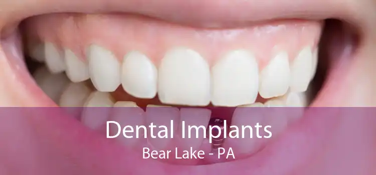 Dental Implants Bear Lake - PA