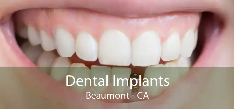 Dental Implants Beaumont - CA