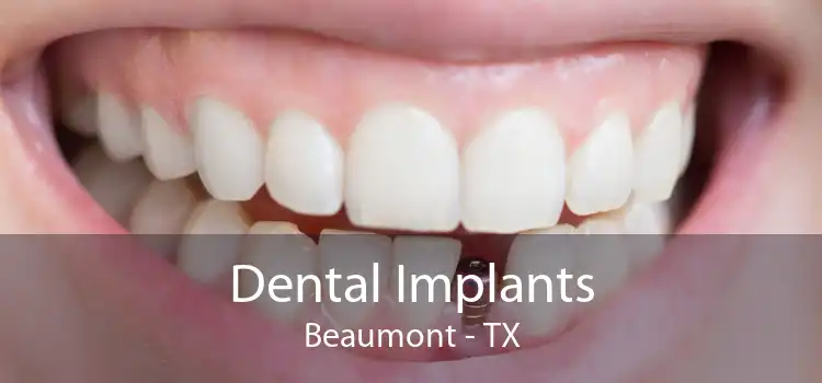 Dental Implants Beaumont - TX