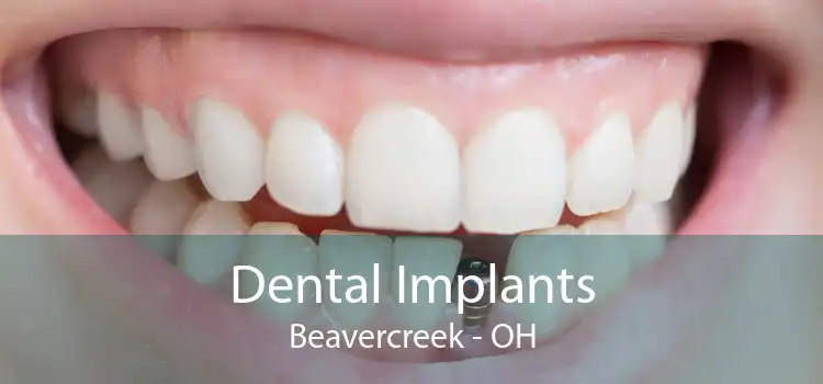 Dental Implants Beavercreek - OH