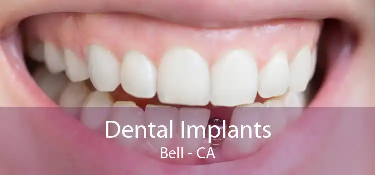 Dental Implants Bell - CA