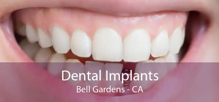 Dental Implants Bell Gardens - CA