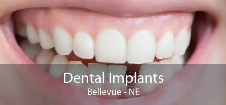 Dental Implants Bellevue - NE
