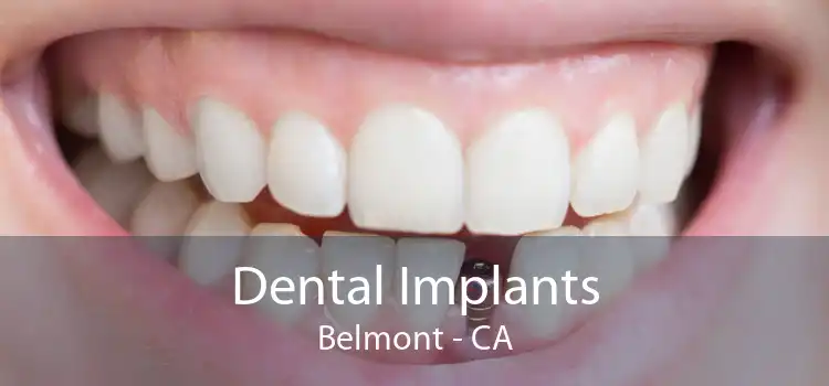 Dental Implants Belmont - CA