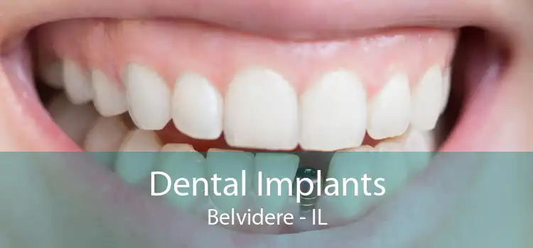 Dental Implants Belvidere - IL