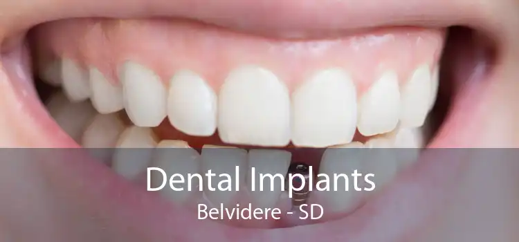 Dental Implants Belvidere - SD