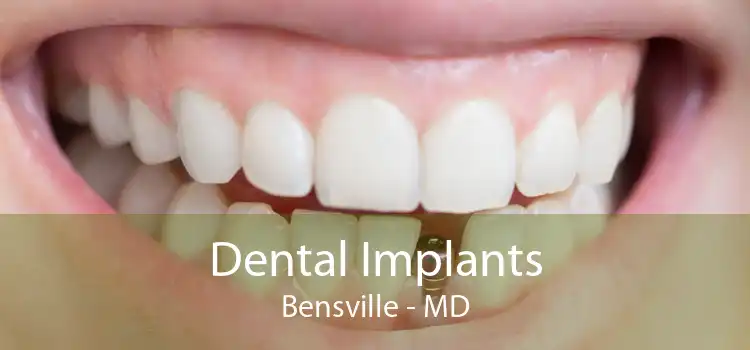 Dental Implants Bensville - MD