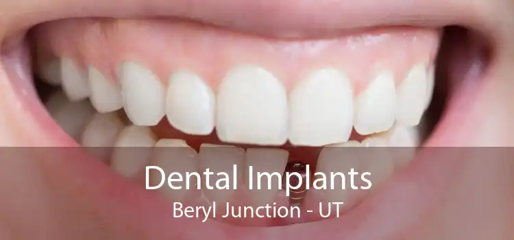 Dental Implants Beryl Junction - UT