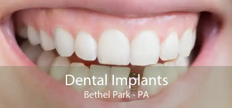 Dental Implants Bethel Park - PA