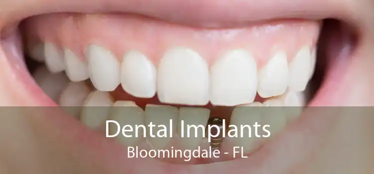 Dental Implants Bloomingdale - FL