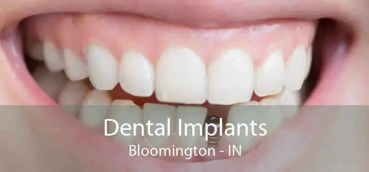 Dental Implants Bloomington - IN