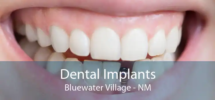Dental Implants Bluewater Village - NM