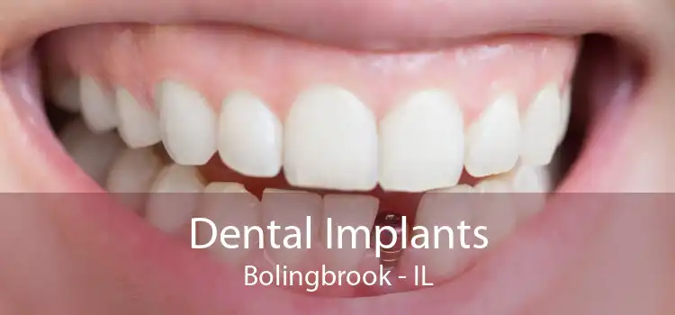 Dental Implants Bolingbrook - IL