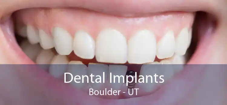 Dental Implants Boulder - UT
