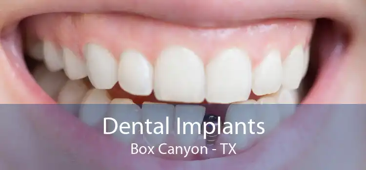 Dental Implants Box Canyon - TX