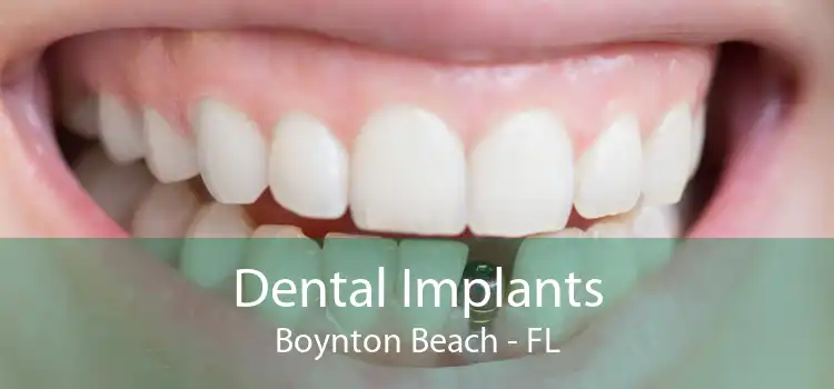 Dental Implants Boynton Beach - FL