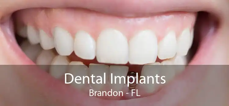 Dental Implants Brandon - FL