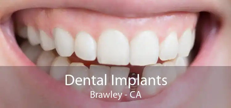 Dental Implants Brawley - CA