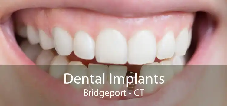 Dental Implants Bridgeport - CT