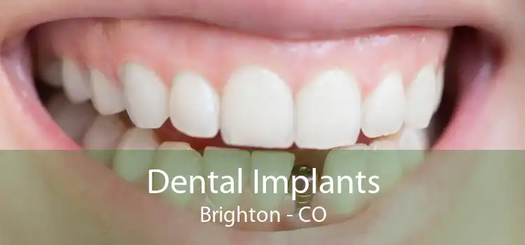 Dental Implants Brighton - CO