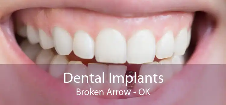Dental Implants Broken Arrow - OK