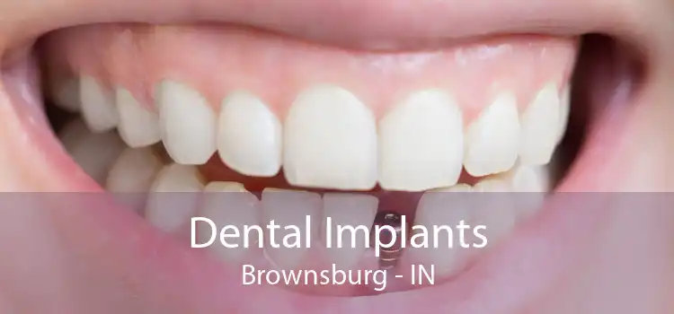 Dental Implants Brownsburg - IN