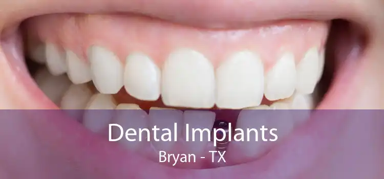 Dental Implants Bryan - TX