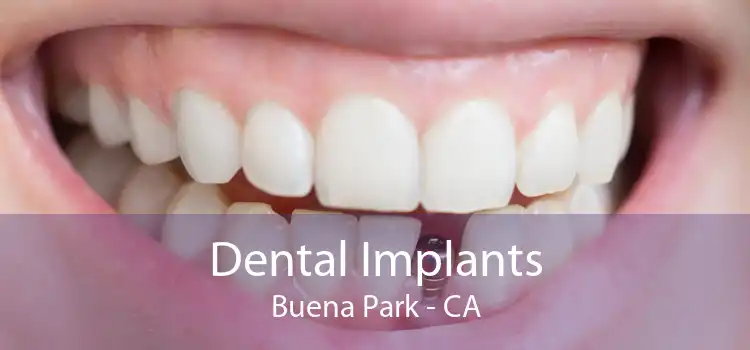 Dental Implants Buena Park - CA