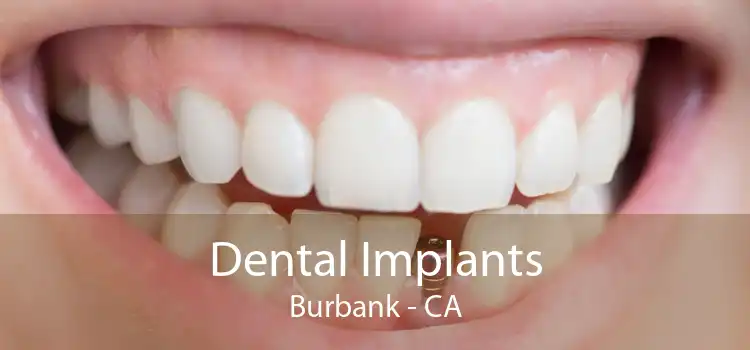 Dental Implants Burbank - CA