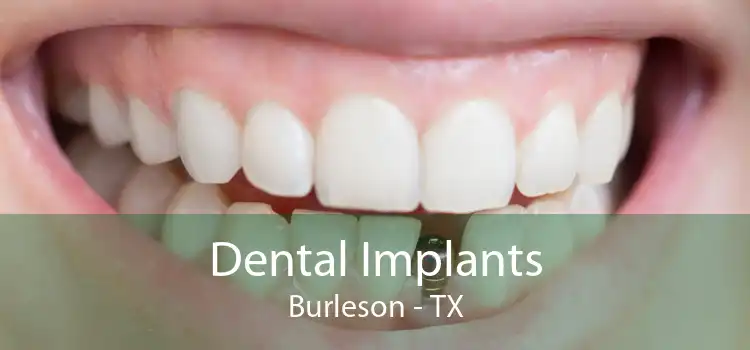 Dental Implants Burleson - TX