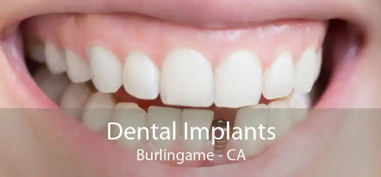 Dental Implants Burlingame - CA