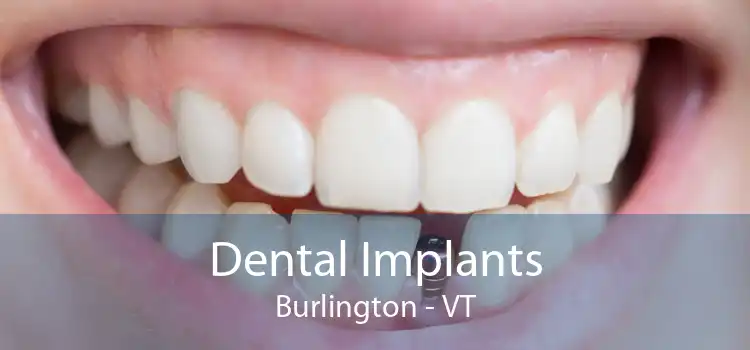 Dental Implants Burlington - VT