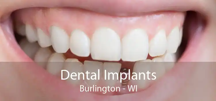 Dental Implants Burlington - WI