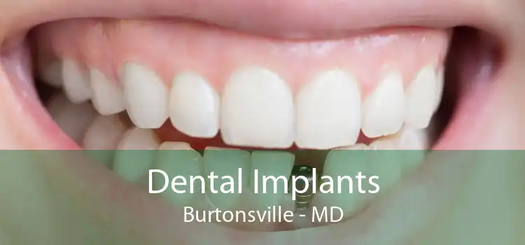 Dental Implants Burtonsville - MD