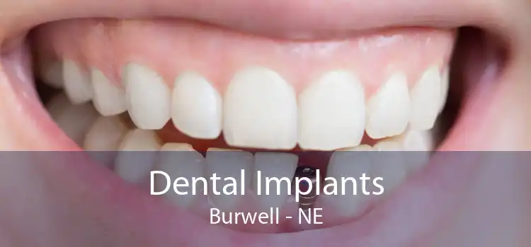 Dental Implants Burwell - NE