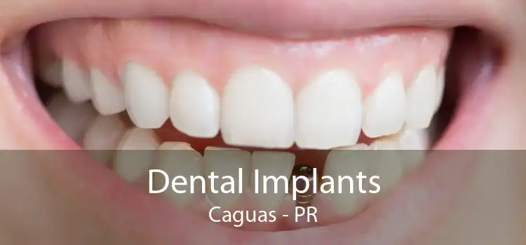 Dental Implants Caguas - PR
