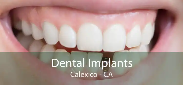Dental Implants Calexico - CA