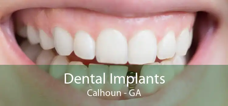 Dental Implants Calhoun - GA