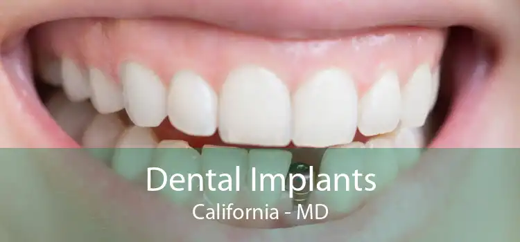 Dental Implants California - MD