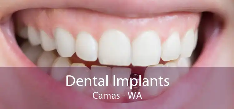 Dental Implants Camas - WA