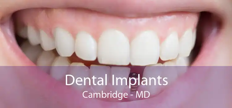 Dental Implants Cambridge - MD