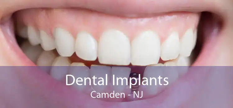 Dental Implants Camden - NJ