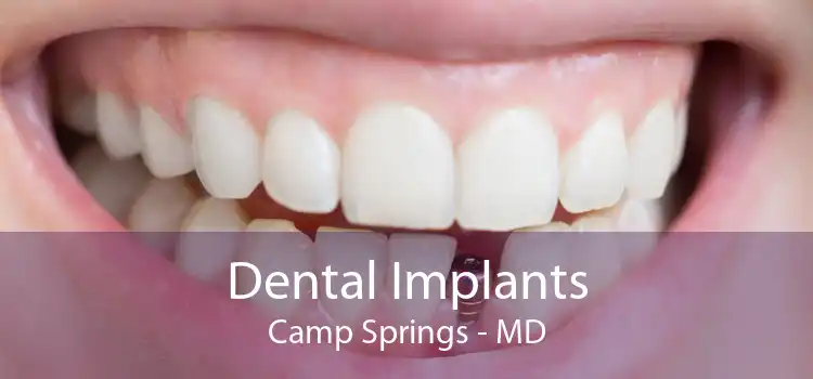 Dental Implants Camp Springs - MD