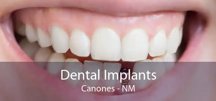 Dental Implants Canones - NM
