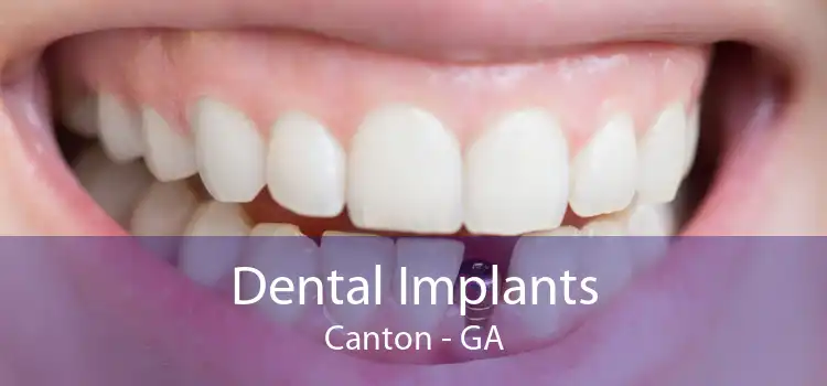 Dental Implants Canton - GA