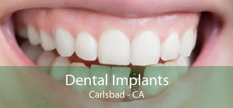 Dental Implants Carlsbad - CA