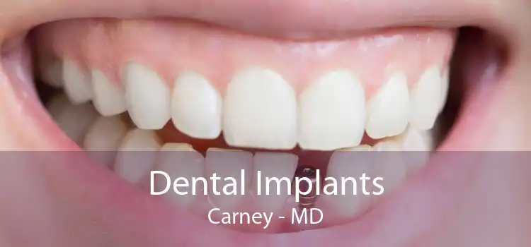 Dental Implants Carney - MD