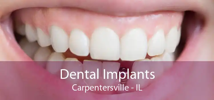 Dental Implants Carpentersville - IL